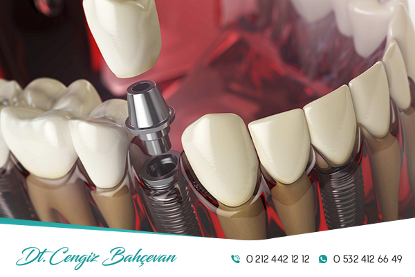 Diyabetli hastalarda diş tedavileri ve implant uygulamaları nasıl yapılır