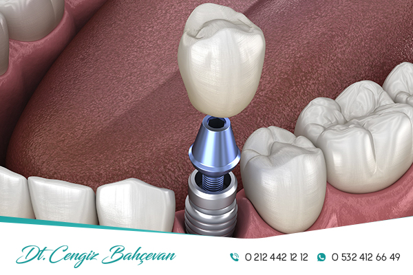 Abutment Nedir