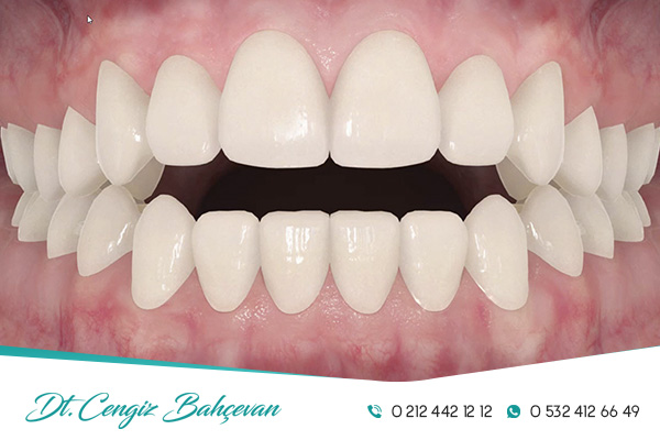 Abrazyon Nedir