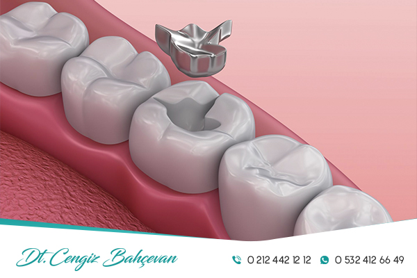 Amalgam Dolgu Nedir