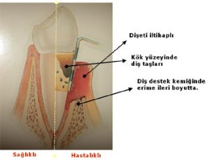 dis-eti-hastaliklari-2