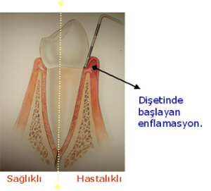 diş eti hastalıkları