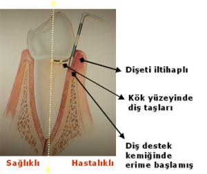dis-eti-hastaliklarindan-nasil-korunulur