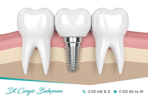 Dental İmplantlar