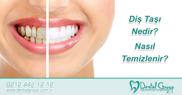 Diş Taşı Nedir Nasıl Temizlenir
